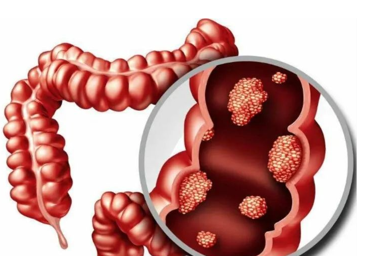 30周年院庆丨 胃肠镜筛查活动，呵护胃肠健康封面图